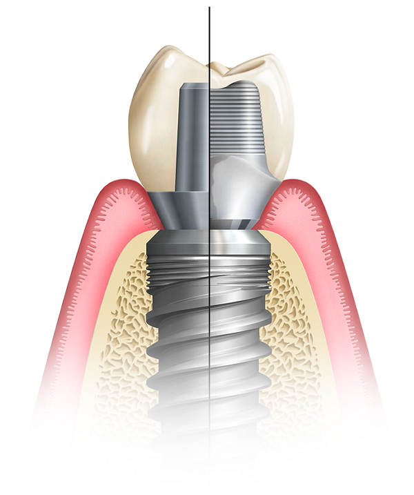 Custom Abutment vs. Stock Abutment The tissue-level junction established by a custom abutment allows for easier cement removal than a stock abutment with shallow margins.