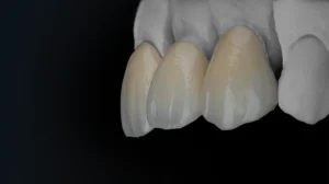 IPS e-MAX