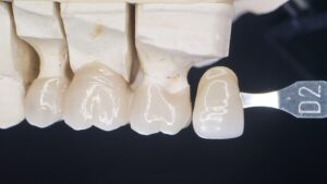 Full-Strength Monolithic Zirconia